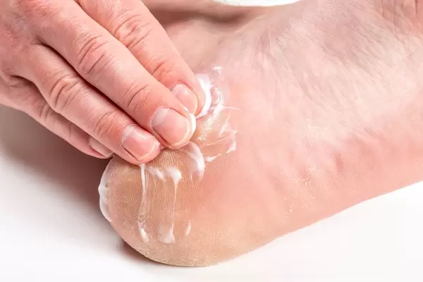A man puts cream on his heel. Foot crack treatment