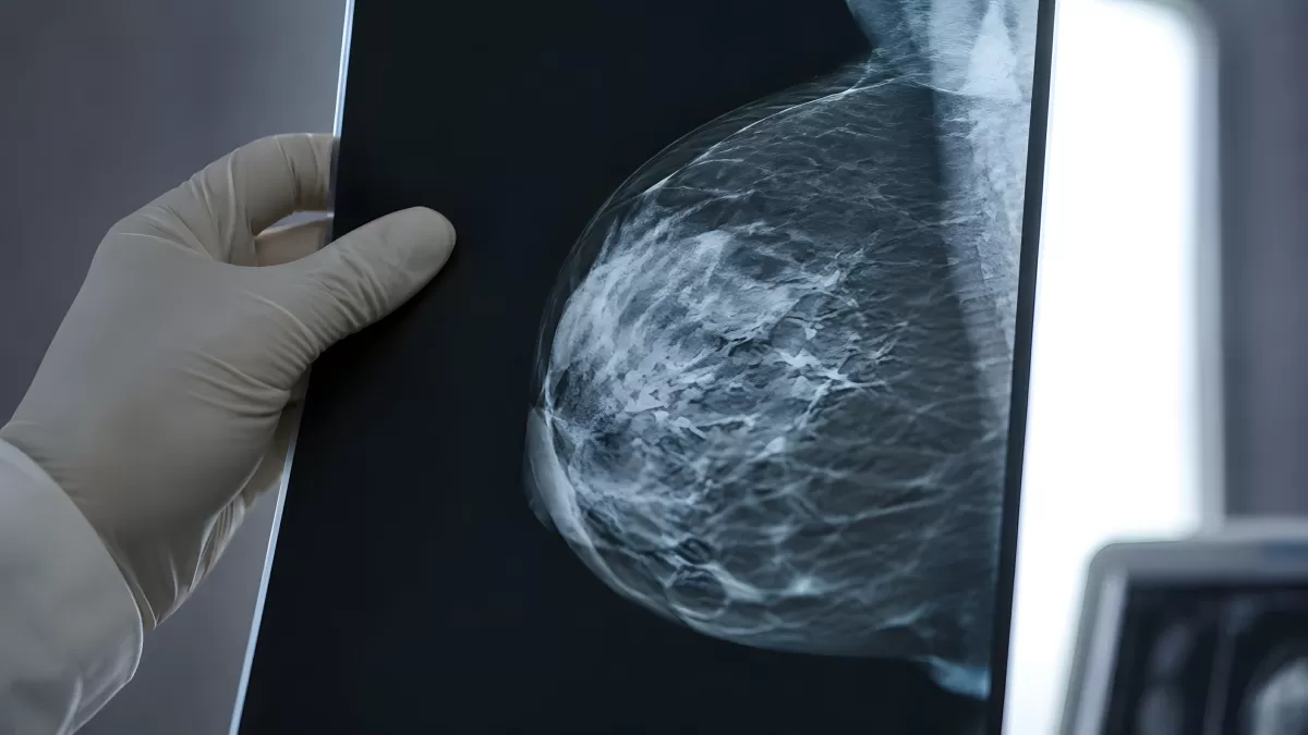 Arzt hält Mammografie-Röntgenbild in der Hand