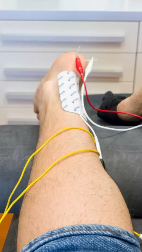 Behandlung eines Fersensporns mit ISM-Therapie