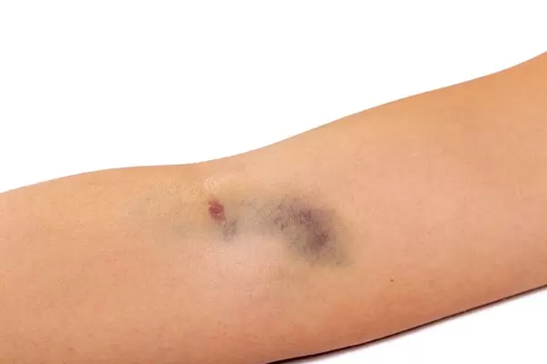 Big bruise on his arm after intravenous injection (Flip 2019)