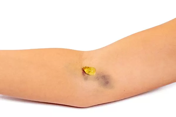 Close - up of a purple bruise on a woman's arm and medical gel (Flip 2019)