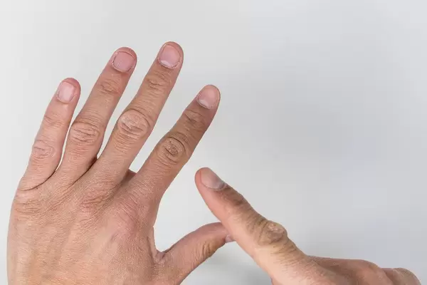 Close up of man's hands with finger pointing at damaged skin