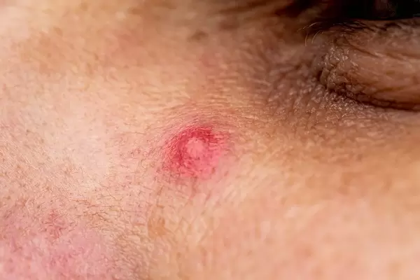 Close up photo of pimple on men's face