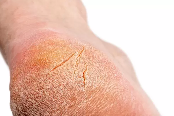 Closeup view of cracks on a heel