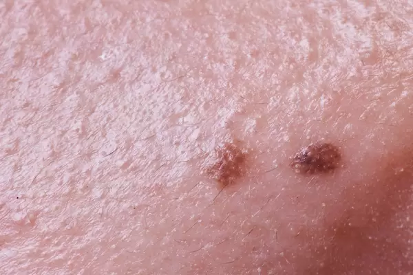 Dangerous nevus on skin - melanoma
