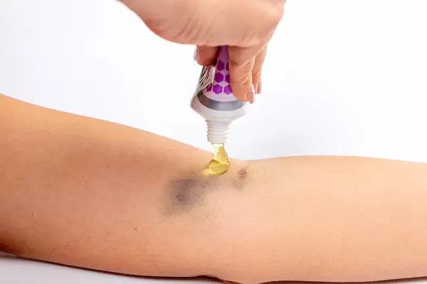 Eine Frau drückt ein medizinisches Gel aus der Tube auf ein Hämatom in der Unterarmkehle