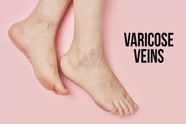 Female feet suffering from varicose veins
