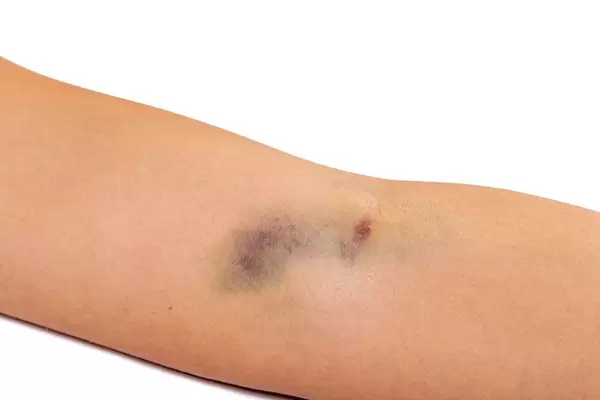 Großer blauer Fleck auf dem Unterarm nach einer intravenösen Injektion