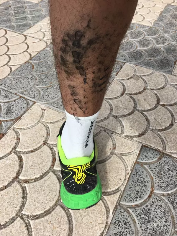 Kettenabdrücke am Unterschenkel