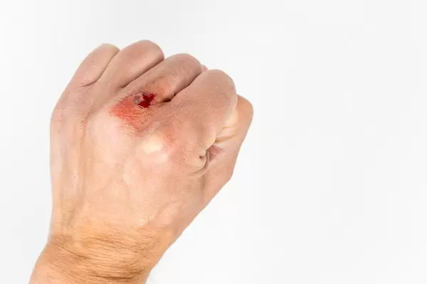 Männliche Hand mit Schürfwunde vor weißem Hintergrund