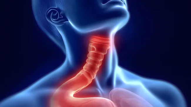 Medizinische Illustration der entzündeten Speiseröhre