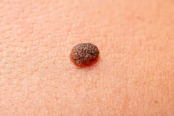 Mole black color on back men