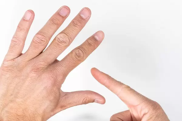 Nahaufnahme von männlichen Händen - ein Finger zeigt Stellen mit geschädigter Haut