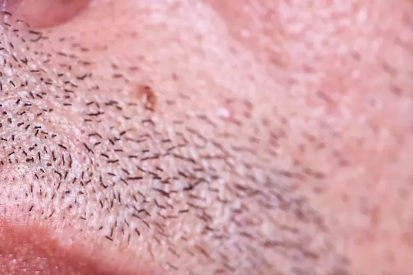 New hairs on beard area. Beard transplant concept