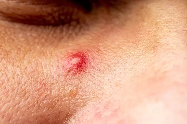 Red purulent pimple on the skin - close-up (Flip 2019)