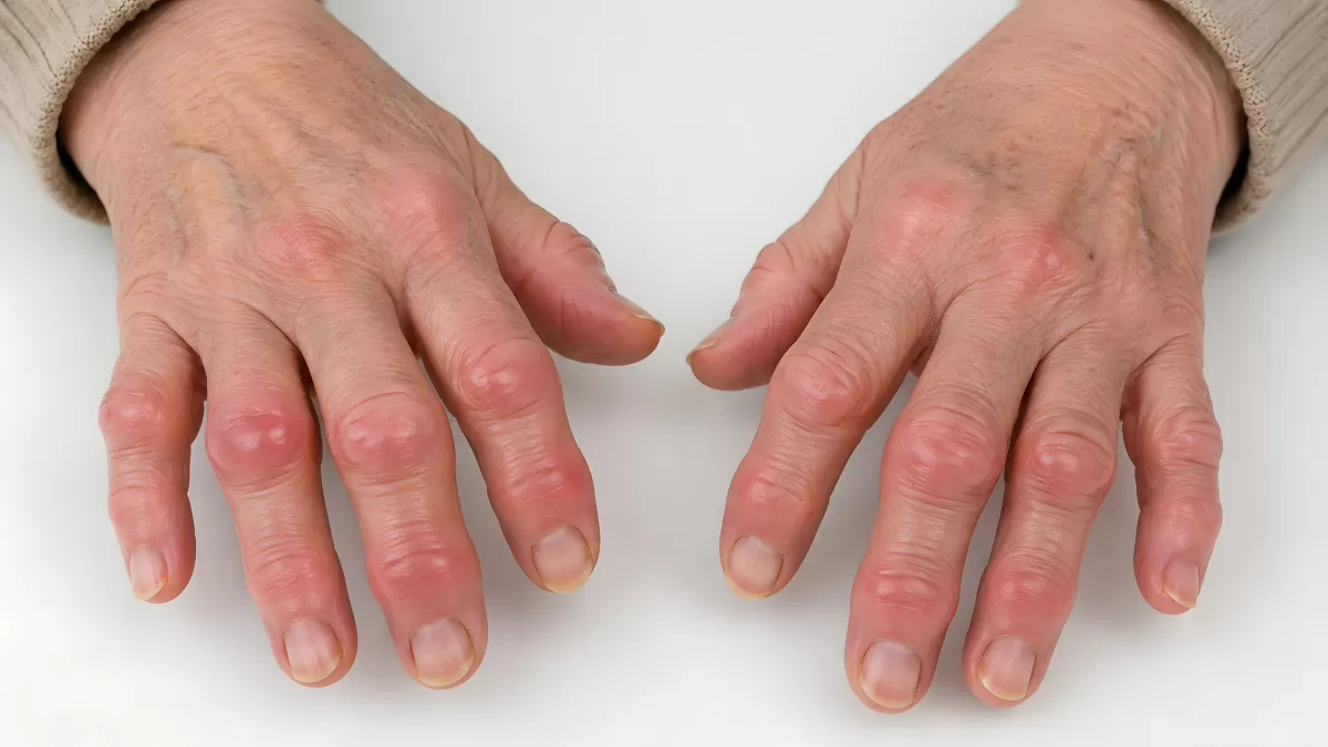 Rheumatoide Arthritis & geschwollene Fingergelenke