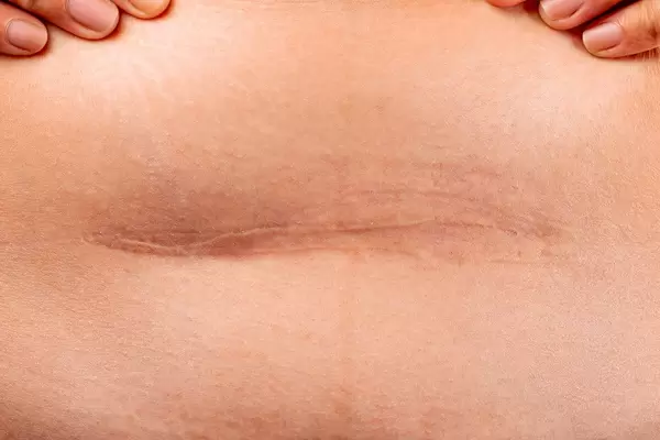 Scar after a cesarean section, close up