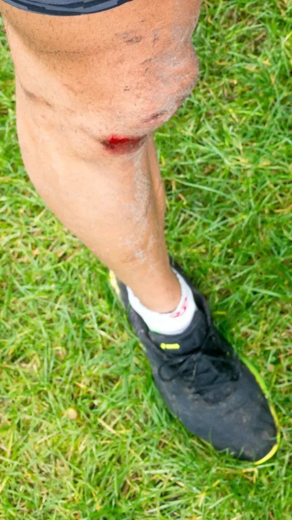 Schürfwunde am Knie