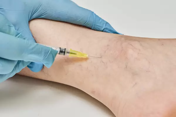 Sclerotherapy for varicose and spider vein treatment