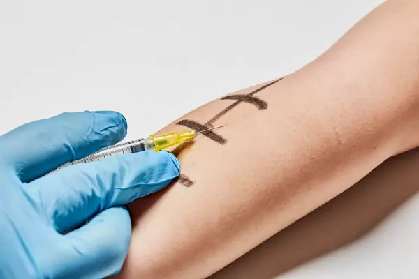 Skin Prick Allergy Testing