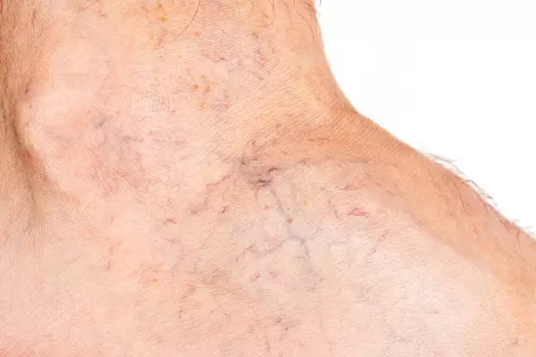 Varicose veins on the skin, close up