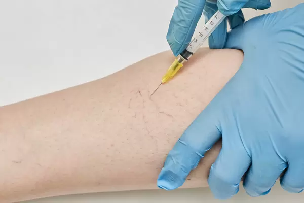 Varicose veins treatment
