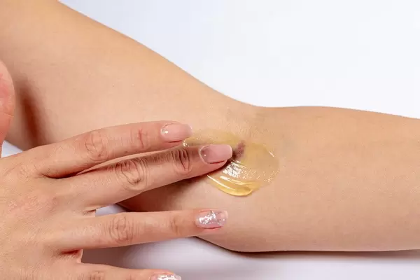 Woman putting medical gel on the bruise after intravenous blood sampling