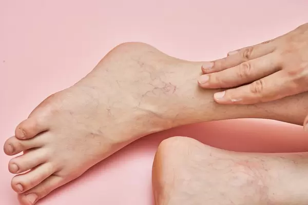 Woman shows leg with varicose veins