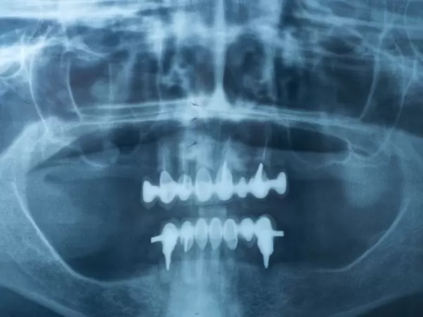 X-ray negative of a human jaw with dental prosthesis