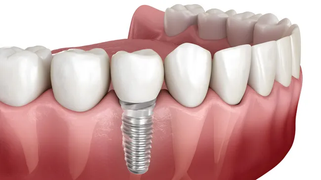Zahnimplantat in realistischer medizinischer Darstellung