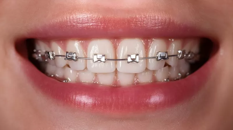 Zahnspange auf lächelndem Mund in Nahaufnahme