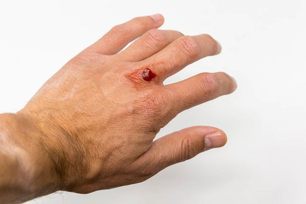 Close-up of a man's hand with a small flesh wound near the finger