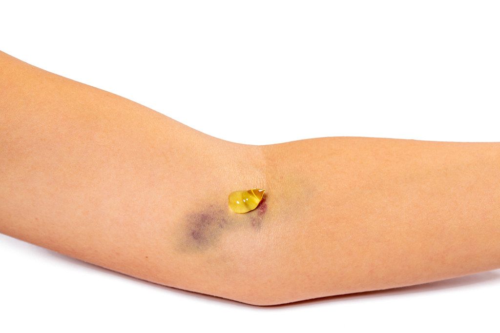Close - up of a purple bruise on a woman's arm and medical gel