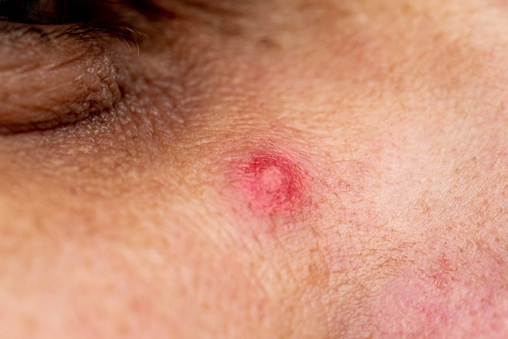 Close up photo of pimple on men's face (Flip 2019)