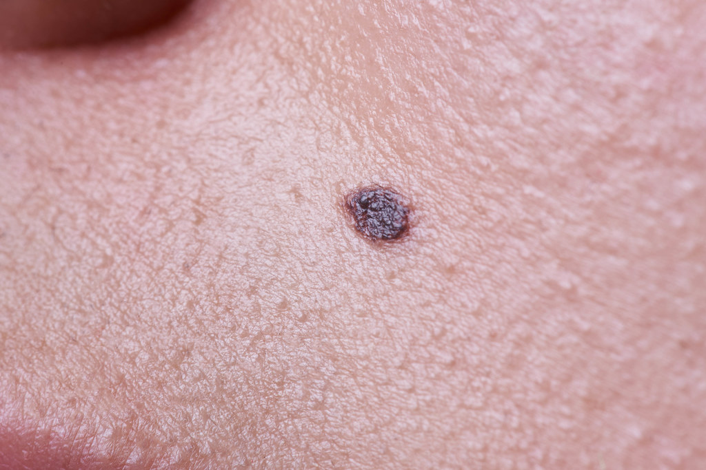 Close-up of a mole on human skin