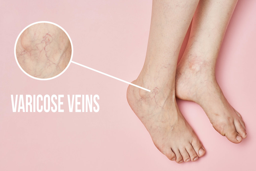 Magnifying varicose veins on women feet