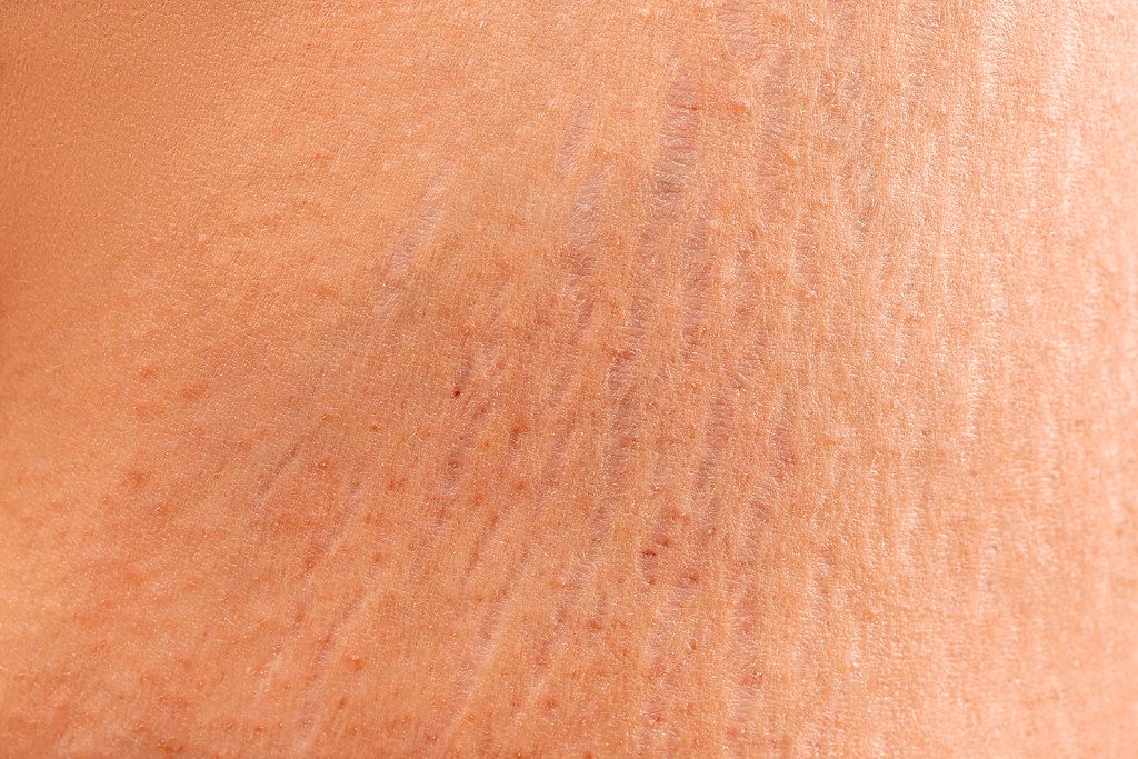 Stretch marks on the skin, wrinkles,obeseness