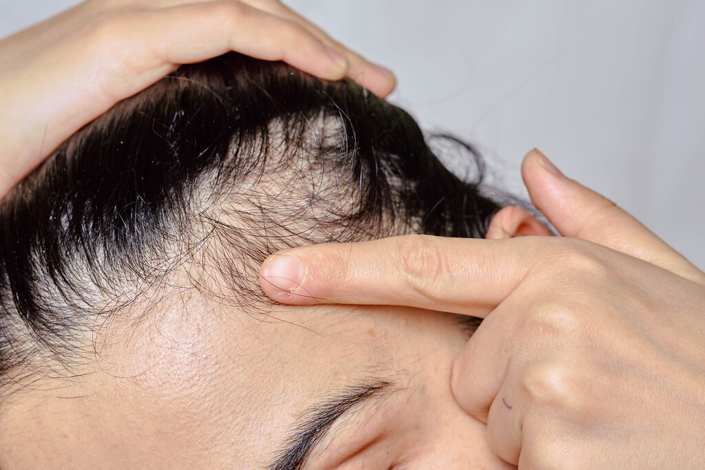Woman showing serious hair loss problem