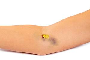 Close - up of a purple bruise on a woman