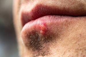 Close up of male unshaven face with herpes on lip (Flip 2019)