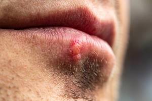 Close up of male unshaven face with herpes on lip