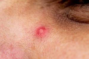 Close up photo of pimple on men