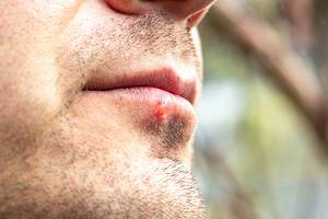 Herpes on the lower lip of a man