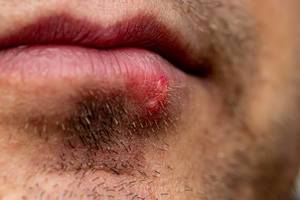 Herpes on the lower lip on male unshaven face (Flip 2019)