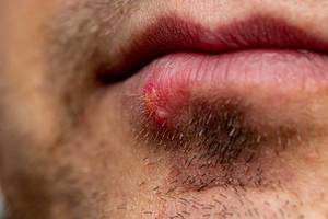 Herpes on the lower lip on male unshaven face