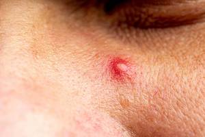 Red purulent pimple on the skin - close-up