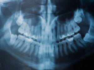 Röntgenbild eines menschlichen Kiefers mit Zähnen. Zahnarztbesuch