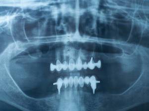 Röntgennegativ eines menschlichen Kiefers mit Zahnprothese